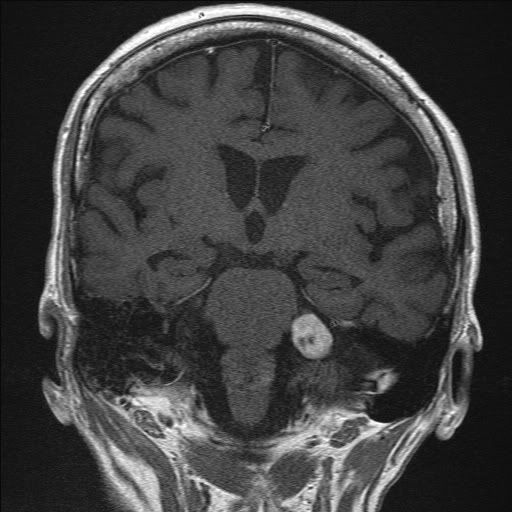 Acoustic Neuronoma (group 3 Swim or Sink)